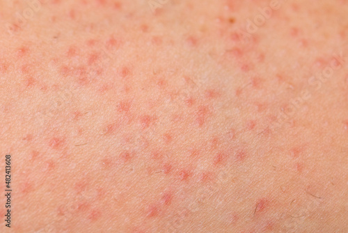 Folliculitis on female skin photo