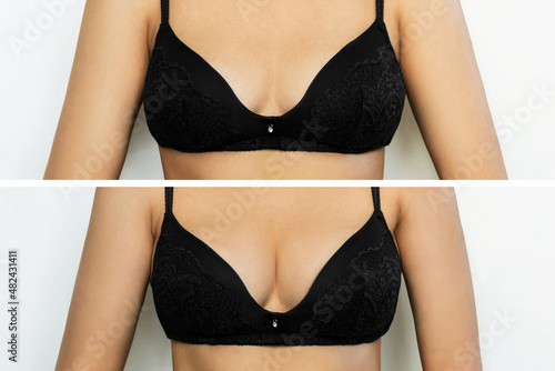 Premium Photo  Young tanned woman in bra before and after breast