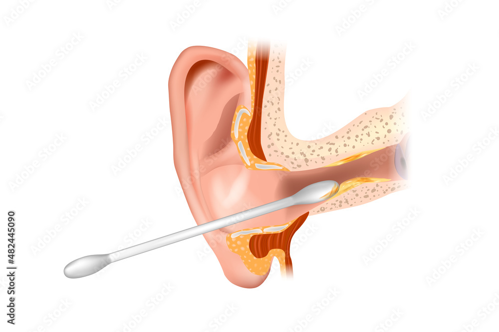 llustration of the ear canal being cleaned with a cotton swab. Section