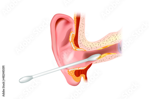 llustration of the ear canal being cleaned with a cotton swab. Section of the ear with the cerumen. Removing earwax and wrong way of using cotton swab. Vector photo