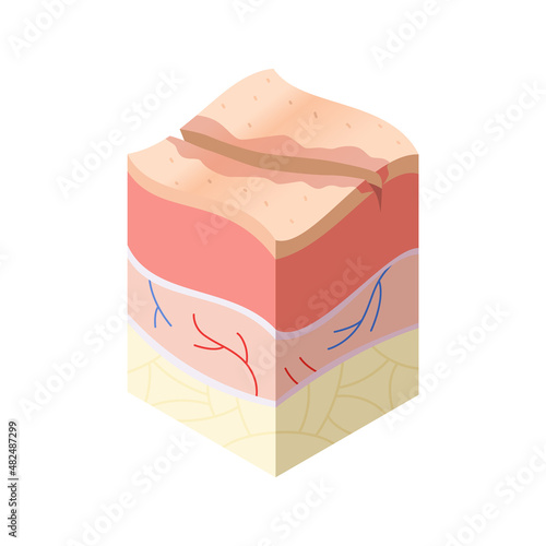 Skincare medical concept. Problems in cross-section of human skin horizontal layers structure. Anatomy illustrative model