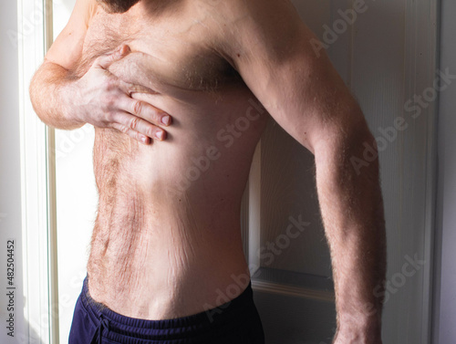 Fit white man after weight loss pulling on his loose skin, stretch marks on the belly.