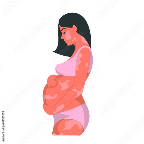 A pregnant, swarthy, dark-haired woman with vitiligo spots on her skin, hugs her big belly with her hands. Vector illustration, flat cartoon color design, isolated on white background, eps 10.