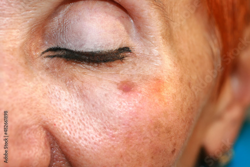 Skin pigmentation. Brown spots of pigmentation on the skin of the face.
