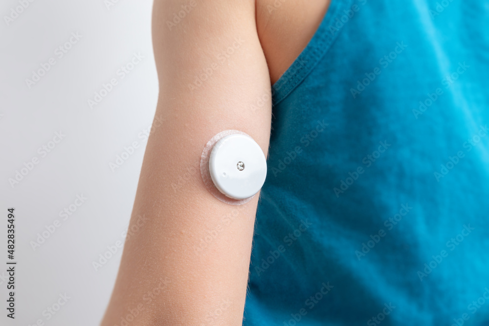 Blood glucose sensor on a child's arm. Sensor for remote measurement of blood  glucose levels using NFC technology on a mobile phone or reader foto de  Stock | Adobe Stock