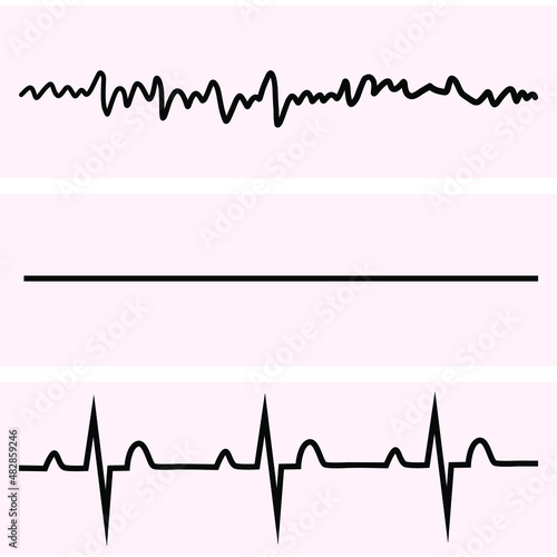 EKG pattern during cardiac arrest including VF asystole and PEA
