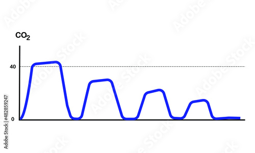 capnography waveform of endotracheal tube displacement from airway