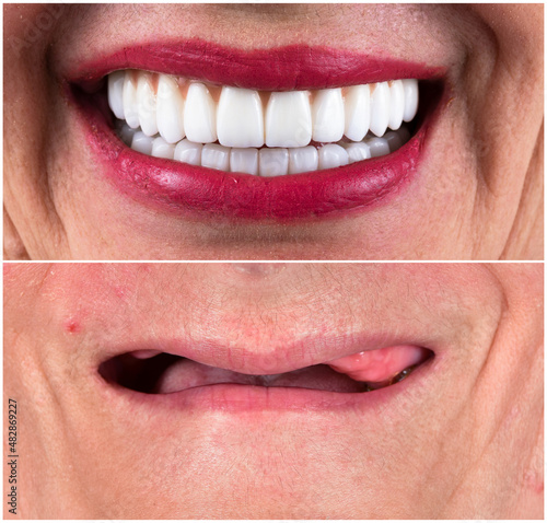 full mouth rehabilitation by crowns veneers and implants