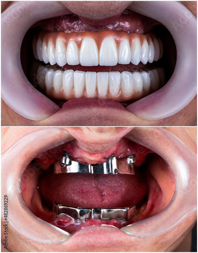 full mouth rehabilitation by crowns veneers and implants