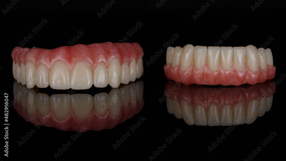 Temporary dentals Upper and lower jaws with rose gums on black glass with reflection Temporary dentals Upper and lower jaws with rose gums on black glass with reflection