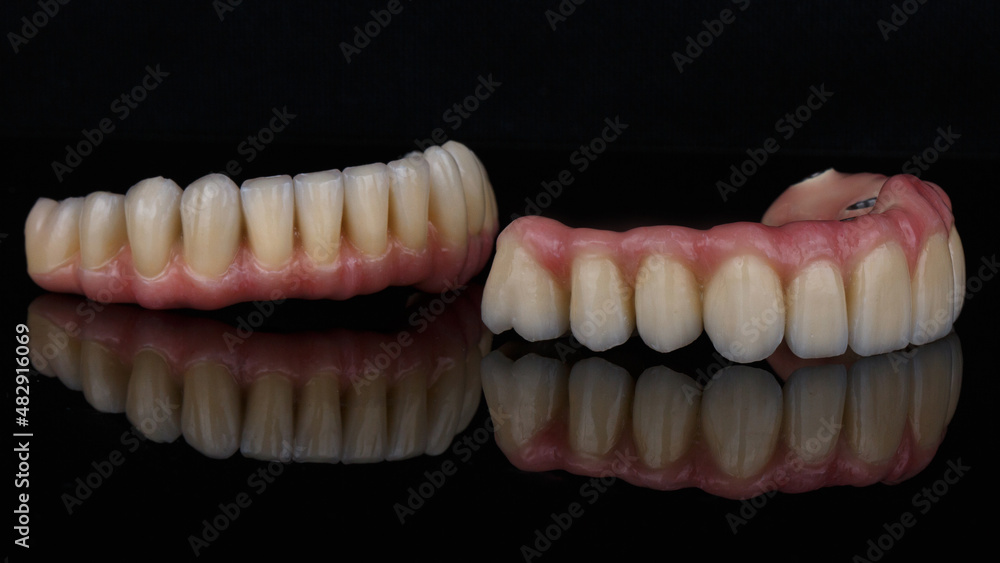 excellent composition of two dental prostheses made of metal and ceramics with pink gums, photo on black glass with creative reflection excellent composition of two dental prostheses made of metal and ceramics with pink gums, photo on black glass with creative reflection