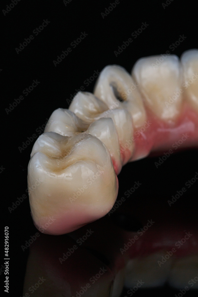 macro photo of the morphology of the prosthesis of the upper jaw on black glass