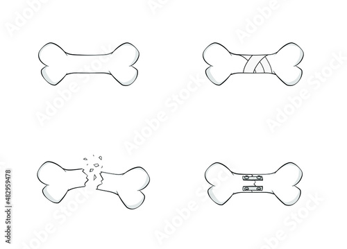 Broken bone fracture fixation plates, screws, nails, rods. Healing bone vector illustration. Anatomy graphic image