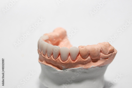 Wallpaper Mural Veneers and crowns by dental technicians try-in the dental models before handing over to the patient insertion dentist. Torontodigital.ca