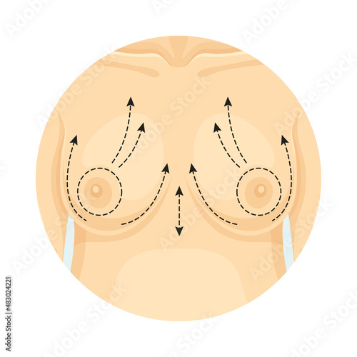 Cosmetic surgery on breast with dotted lines. Front view of female body. Plastic surgery vector illustration