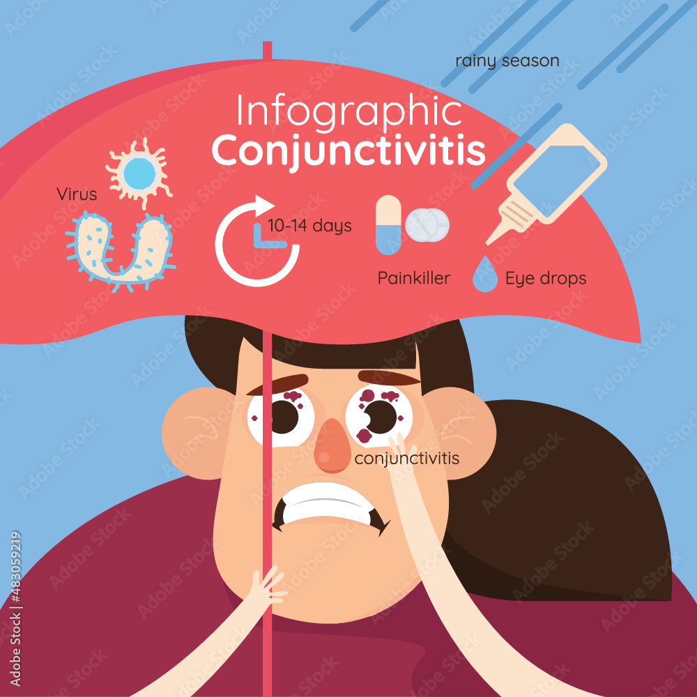 Conjunctivitis. Redness and inflammation of the eye. Vessels in the eye ...