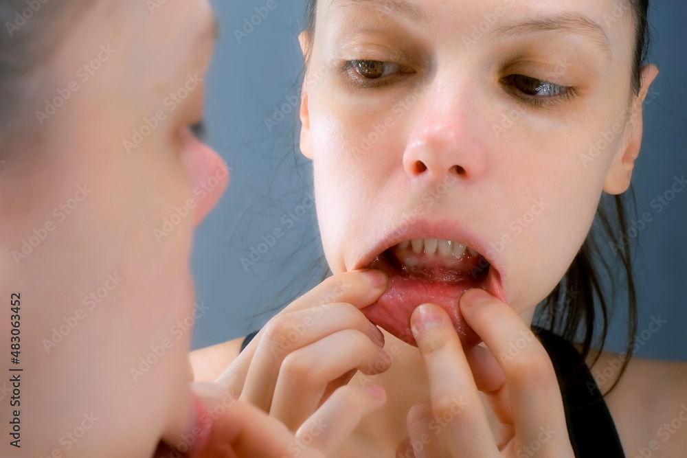 Stomatitis in woman's mouth after dental treatment, disease in the mouth. Stomatitis on the lower lip. Large ulcers in the mouth under the lower teeth. Woman is looking at mirror. Stomatitis in woman's mouth after dental treatment, disease in the mouth. Stomatitis on the lower lip. Large ulcers in the mouth under the lower teeth. Woman is looking at mirror.