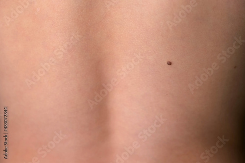 Boy's white skin in back with big brown mole before laser removing. Birthmark, melanoma and nevus on teen's skin. photo