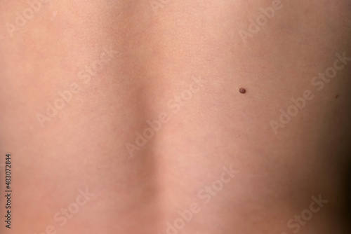 Foto Boy's white skin in back with big brown mole before laser removing
