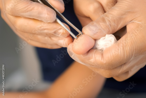 Surgeon is removing wart on teen boy s thumb finger using surgical forceps in hospital  hands in gloves. Remove papillomavirus verruca on hand. One day surgery concept. Sore and wound after operation.