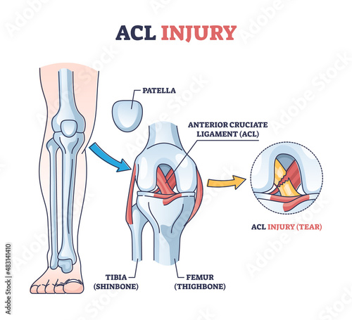 ACL injury or trauma as tear or sprain of anterior cruciate outline concept. Labeled educational leg or knee pain anatomical explanation with bone and ligament medical structure vector illustration.