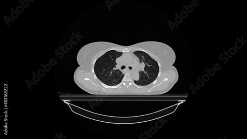The CT scan of the middle-aged female patient reveals a lung tumor in the lower left lobe of the lung. After further investigations, a small cell lung carcinoma (SCLC) was diagnosed. photo
