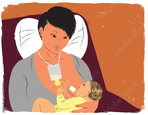 Φωτογραφία Mother breastfeeding baby with a supplemental nursing system