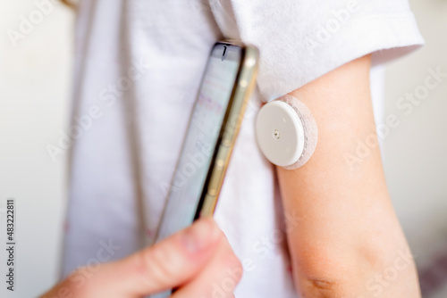 CGM -system of continuous monitoring of glucose on child's arm.
