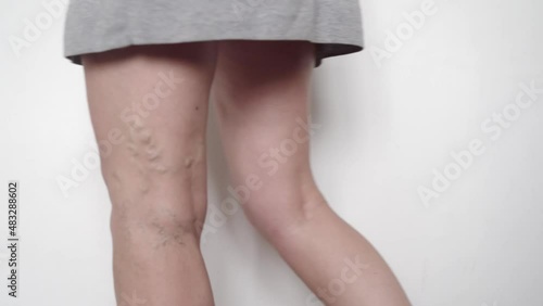 close up of woman legs with varicose veins. Spider vein texture on legs, vascular medical problem. Elderly woman care