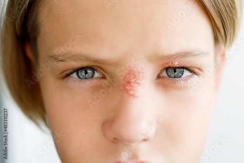 Принти на полотні Rash on the face of a child, on the nose and eye, close-up: herpes, virus, infection, conjunctivitis, allergy - medical concept