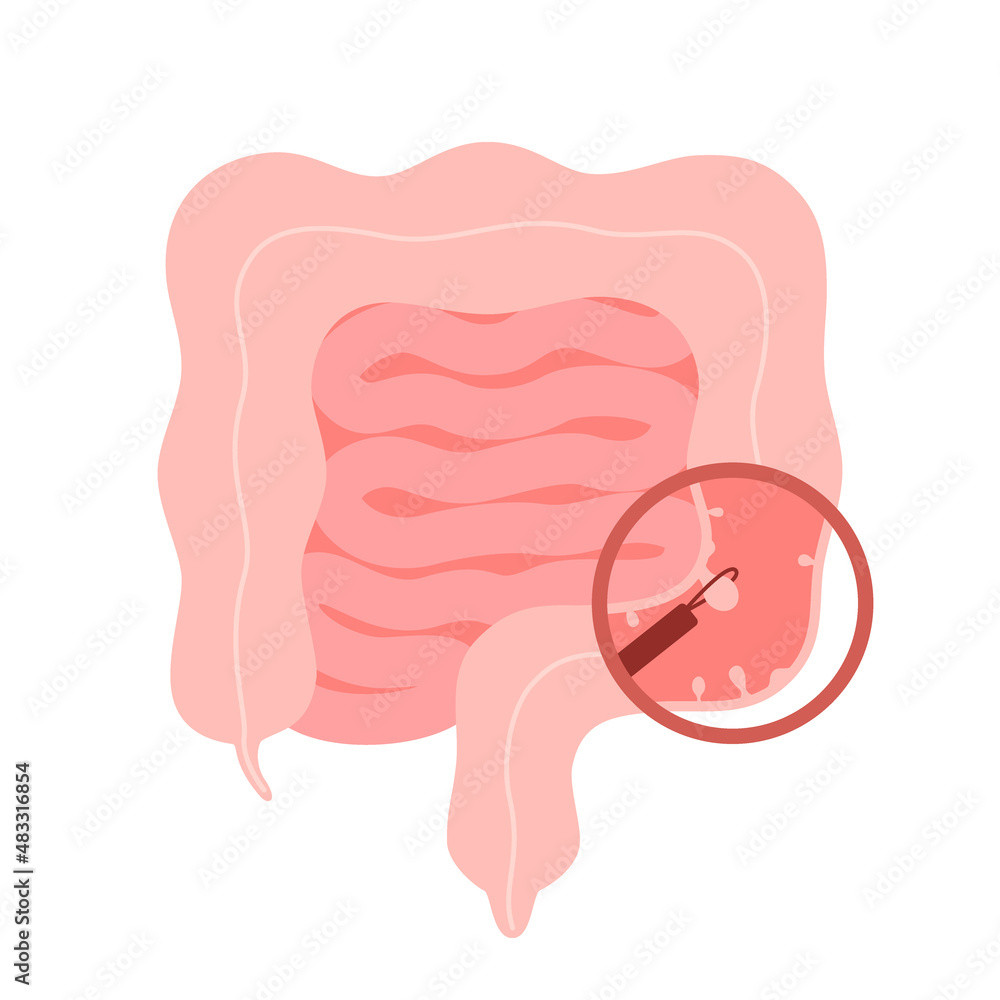 Colonoscopy intestine, polypectomy procedure, removal polyp in colon. Checkup gut, colon surgery. Operation intestine. Vector illustration Colonoscopy intestine, polypectomy procedure, removal polyp in colon. Checkup gut, colon surgery. Operation intestine. Vector illustration
