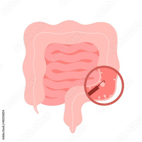 Colonoscopy intestine, polypectomy procedure, removal polyp in colon. Checkup gut, colon surgery. Operation intestine. Vector illustration