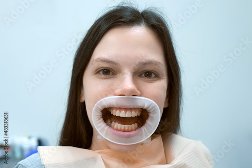 Portrait of happy woman with yellow teeth with retractor in her mouth is waiting dentist. She is in dentistry. Dental treatment and teeth cure concept.