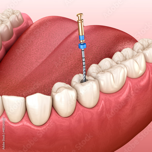 Endodontic root canal treatment process. Medically accurate tooth 3D illustration. photo