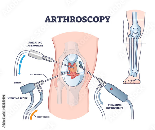 Arthroscopy procedure process explanation from medical view outline diagram. Labeled educational knee joint diagnosis and treatment with trimming instrument, scope and irrigation vector illustration. photo