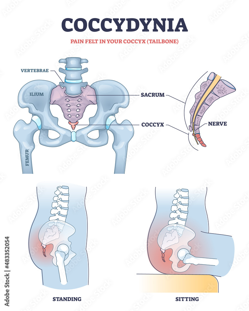 Coccydynia as pain felt in coccyx or tailbone anatomical outline diagram. Labeled educational back bone structure and painful nerve in standing or sitting positions vector illustration. Medical scheme - obrazy, fototapety, plakaty 