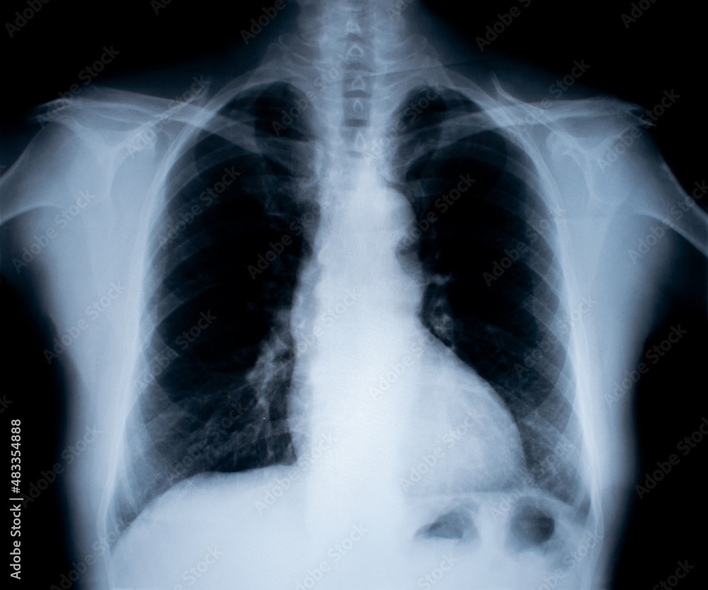 X-Ray image isolated on white X-Ray image isolated on white