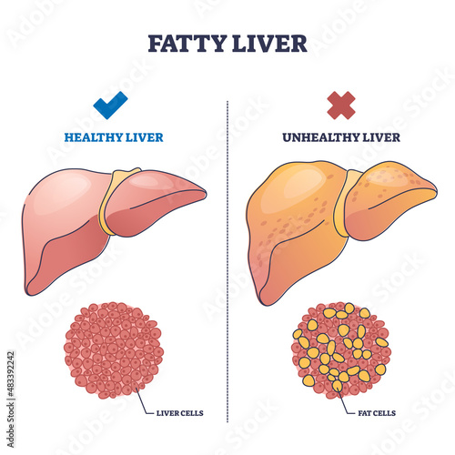 Fatty liver disease with healthy and damaged organ comparison outline diagram. Labeled educational fat cells amount on alcoholic or overweight body vector illustration. Anatomical illness explanation.