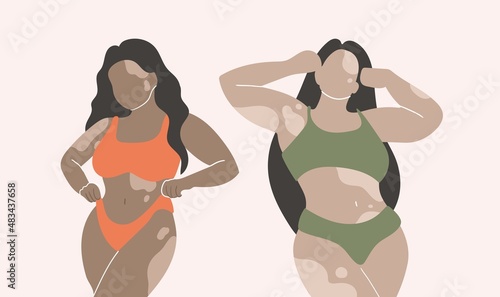 Body-positive women collection. Vector illustration of pretty women vitiligo of different nationalities. Self Acceptance and Beauty Diversity Concept. Isolated on white