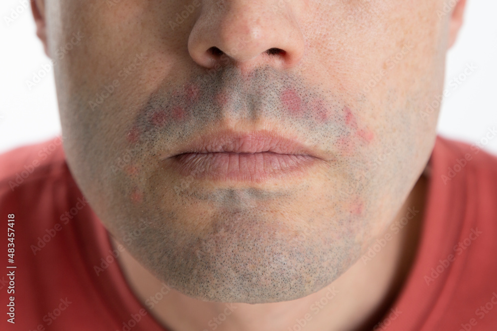 chin of a man with dermatitis after shaving. Male skin problems and irritation chin of a man with dermatitis after shaving. Male skin problems and irritation