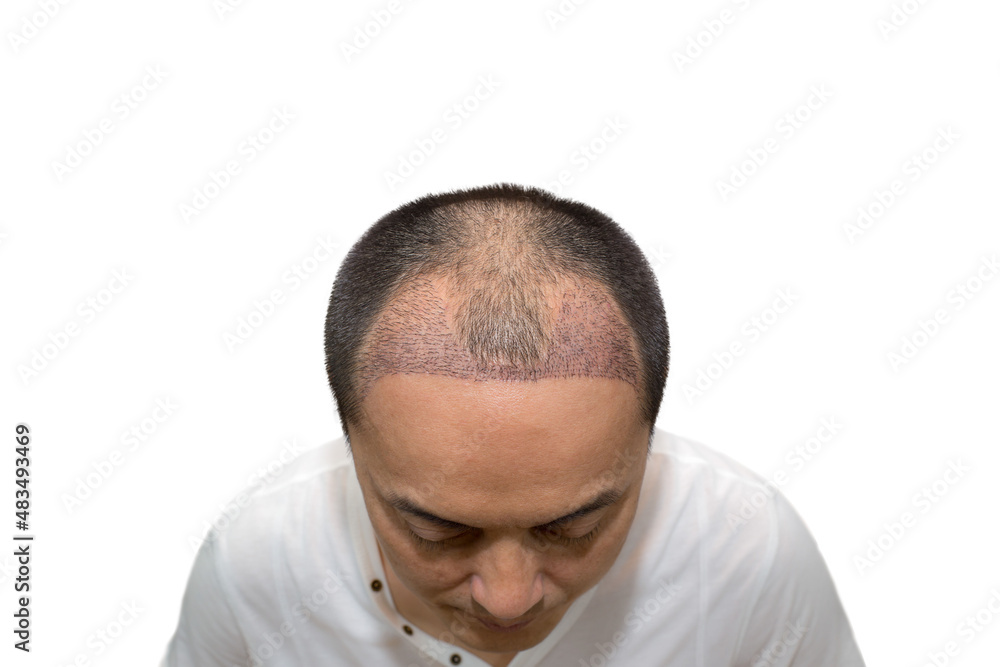 Close up top view of a man's head with hair transplant surgery with a receding hair line. Close up top view of a man's head with hair transplant surgery with a receding hair line.