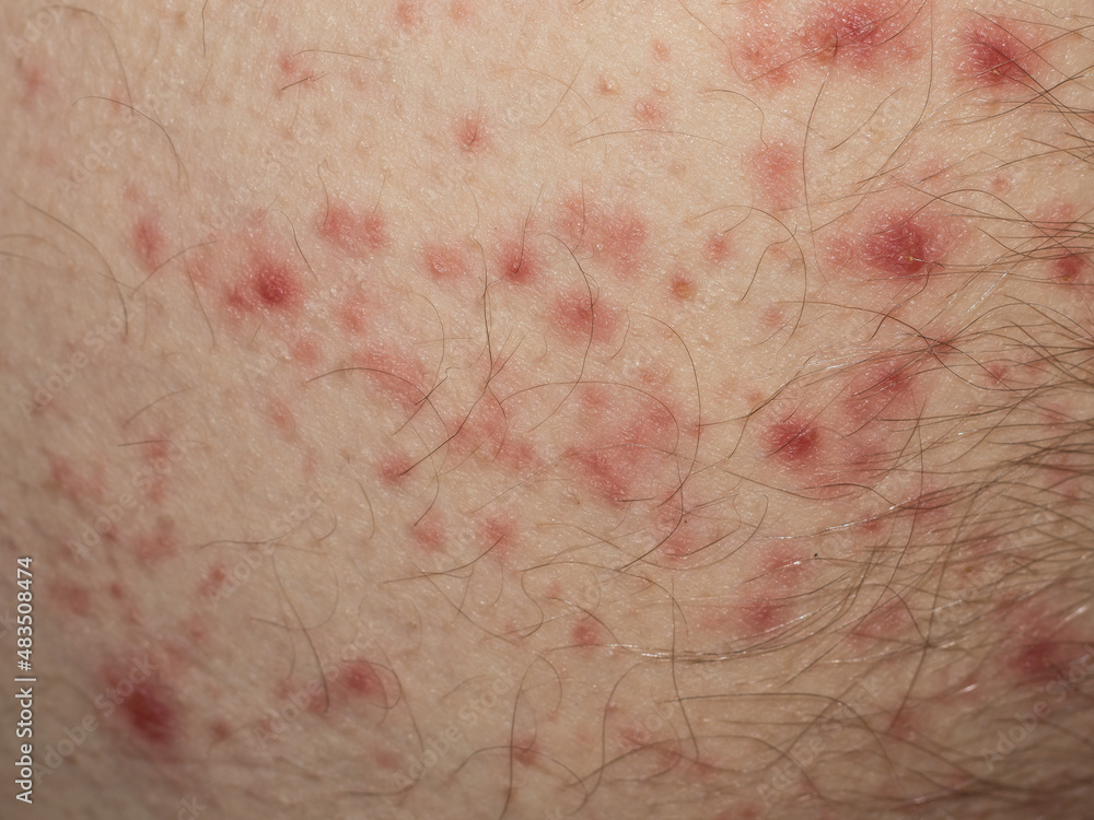 Fototapeta premium detail of scarlet fever in an adult caucasian man