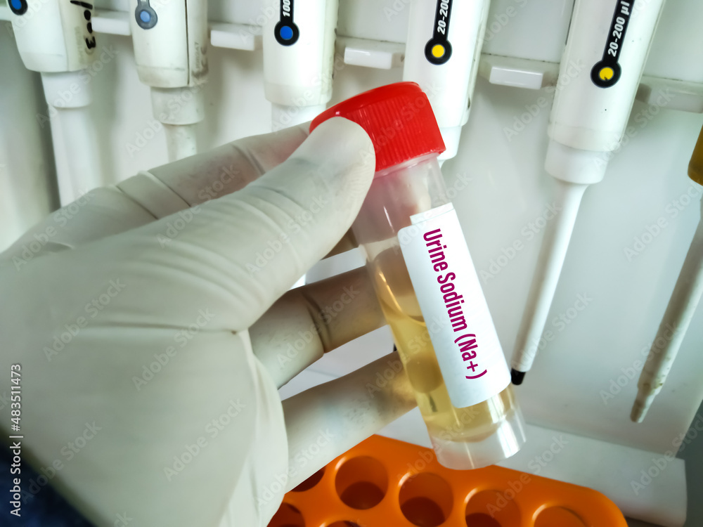 Urine sample for electrolytes test. Electrolytes are salts and minerals like sodium, potassium