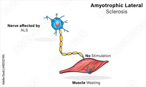 Amyotrophic Lateral Sclerosis Pathogenesis, Detailed Vector Illustration of Nerve and Muscle Cell Degeneration in White Background for Medical Education and Research.