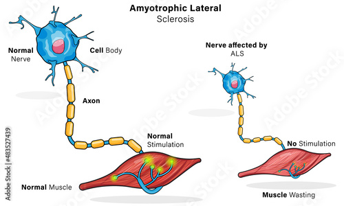 Amyotrophic Lateral Sclerosis Pathogenesis, Detailed Vector Illustration of Nerve and Muscle Cell Degeneration in White Background for Medical Education and Research.