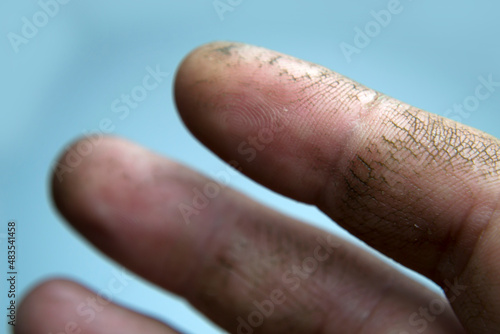 Cracked skin on the fingers, dry skin. Your cream will help these hands. Lack of vitamins.