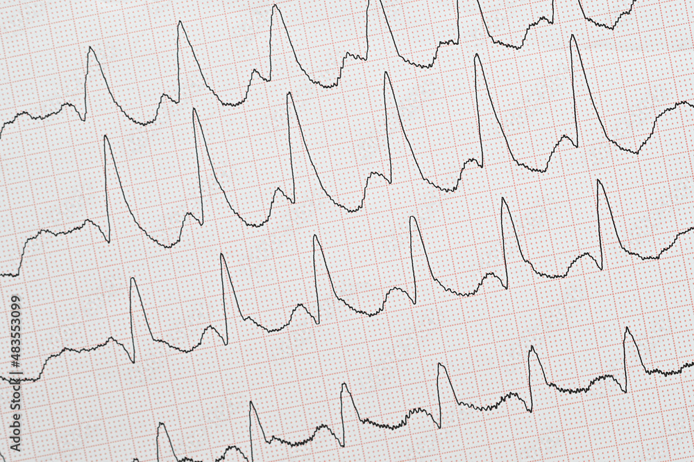 EKG-Ableitungen mit komplettem Rechtsschenkelblock