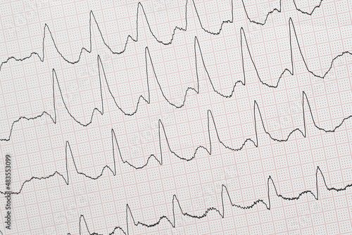 EKG-Ableitungen mit komplettem Rechtsschenkelblock photo