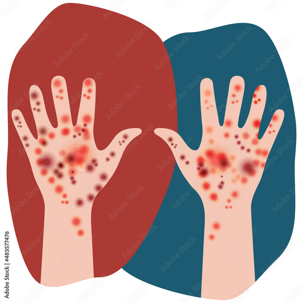 Two hands raised up. Manifestation of skin disease signs in people with