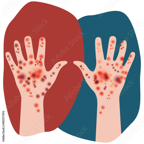 Two hands raised up. Manifestation of skin disease signs in people with white skin tone. Rash on both human hands. Irritation, rash, dermatitis. Design for medicine or dermatology, medical sites, app.